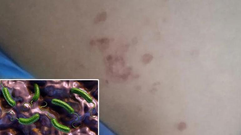 Serinlemek için girdi, yanıkla çıktı! Denizde enfeksiyon paniği: 'Buradan vücuda giriyor'